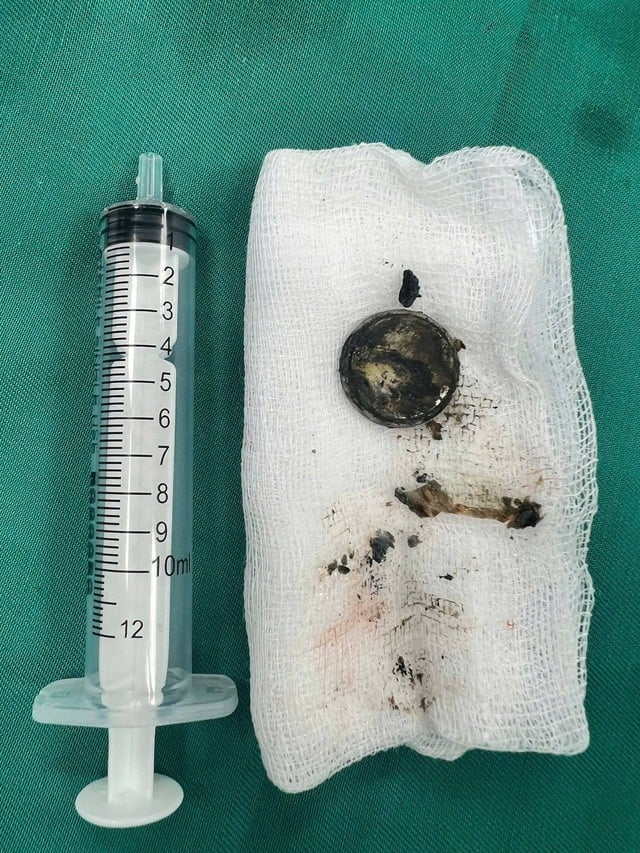 Un bambino di due anni riporta gravi ustioni esofagee dopo aver ingerito una batteria a bottone - Foto 2. Nuốt pin cúc áo, bé 2 tuổi bỏng nặng thực quản- Ảnh 2.