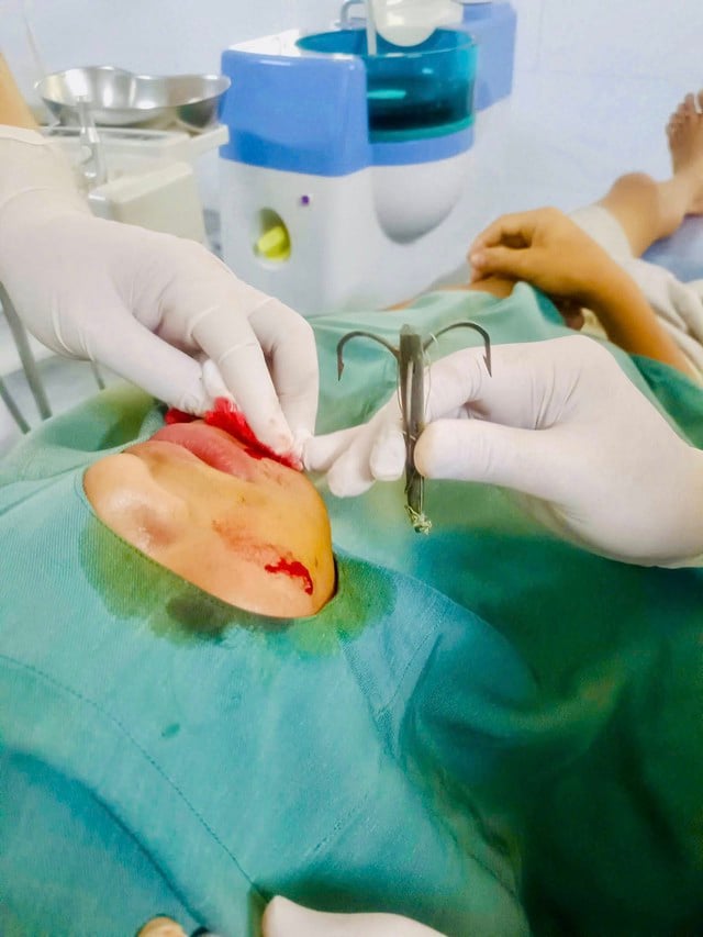 Đi câu cá, lưỡi câu móc vào má- Ảnh 2.