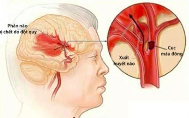 Nhận biết và xử trí chấn thương sọ não- Ảnh 1.