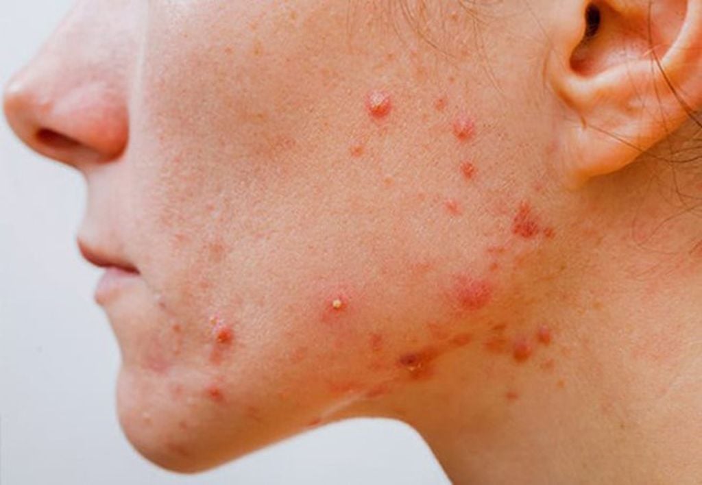 7 yếu tố dẫn đến tình trạng mụn viêm trên da- Ảnh 1.