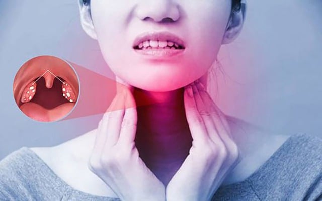 Tại sao viêm họng hạt dễ tái phát?- Ảnh 1.