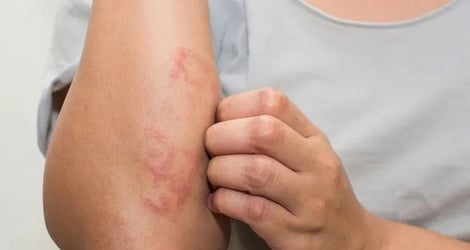대상포진 합병증 경고 관련 이미지