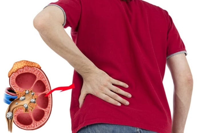 I calcoli renali possono causare disfunzione erettile? - Immagine 1. Sỏi thận có gây rối loạn cương dương?- Ảnh 1.