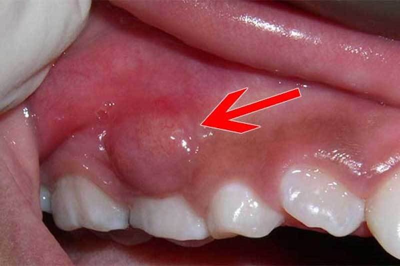Cảnh báo biến chứng nguy hiểm của áp xe răng- Ảnh 1.