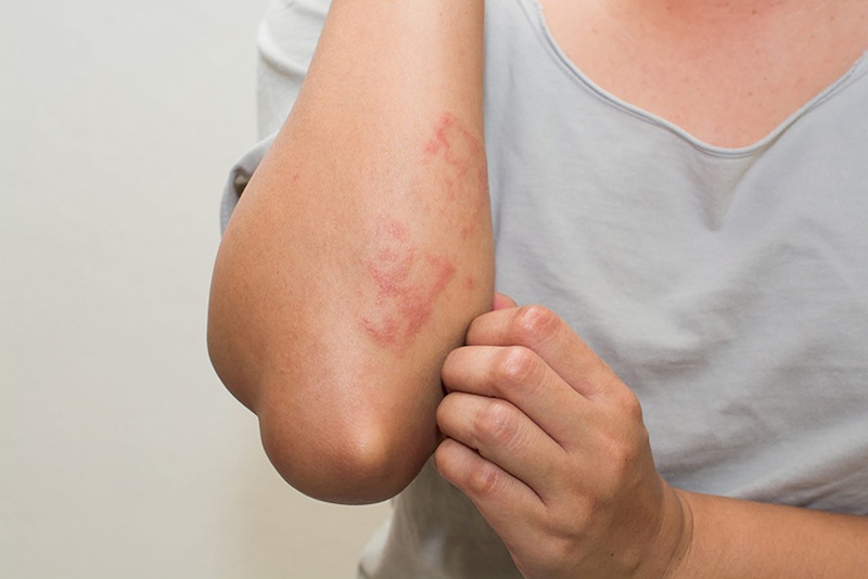 ruption cutane rouge et irritante : signe d'une allergie ou signe  avant-coureur d'une affection mdicale sous-jacente ?