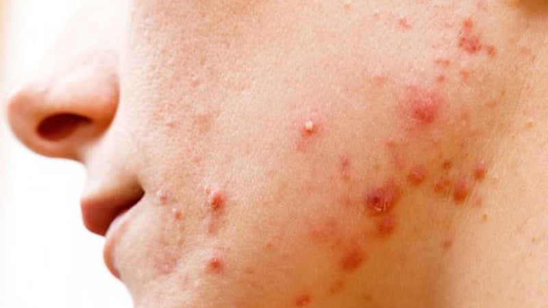 Mụn trứng cá bọc có nên nặn không?- Ảnh 1.