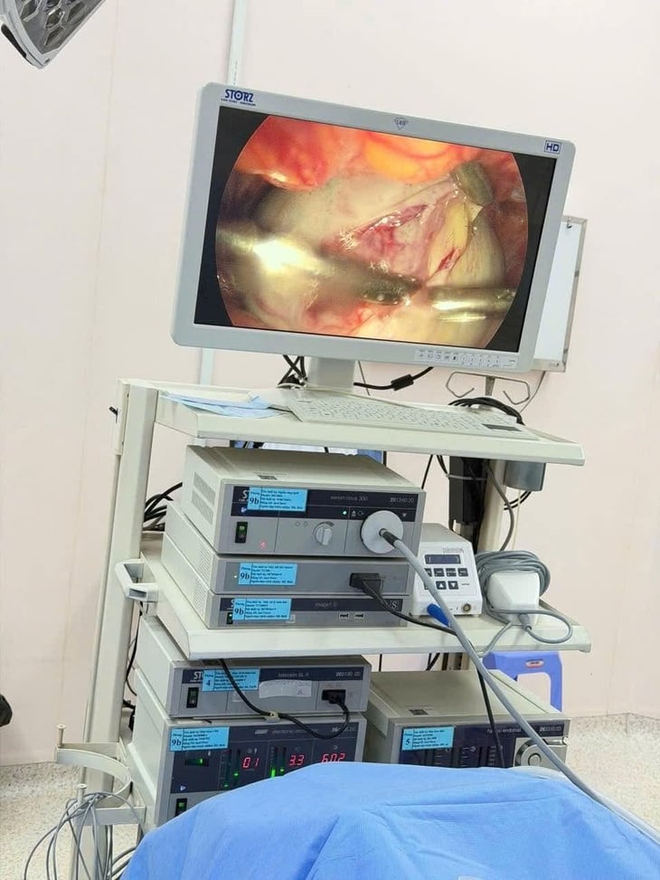Tumor ovarium - Foto 3.
