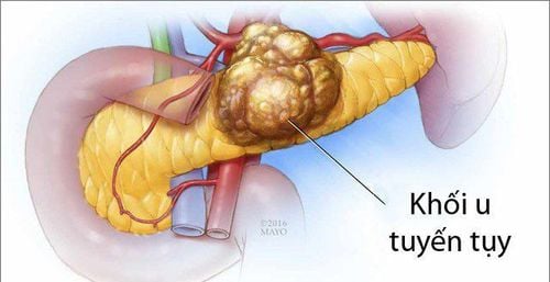6 signes de cancer du pancréas, reconnaissez-les tôt pour un traitement rapide - Image 1. 6 dấu hiệu ung thư tụy, nhận biết sớm để điều trị kịp thời- Ảnh 1.