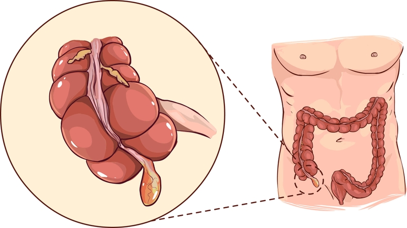 Viêm ruột thừa dễ nhầm lẫn và có thể gây biến chứng gì?- Ảnh 1.