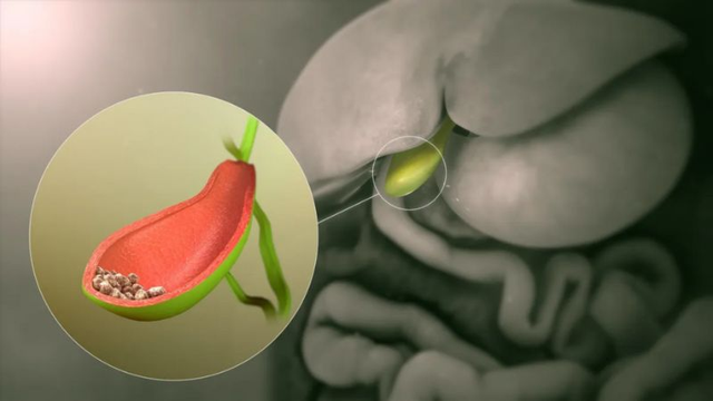 Sỏi túi mật hình thành do đâu và cách phòng ngừa hiệu quả- Ảnh 1.