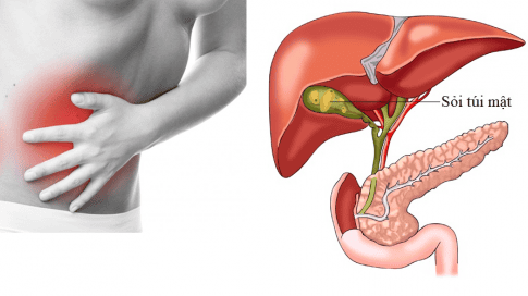 Sỏi túi mật hình thành do đâu và cách phòng ngừa hiệu quả- Ảnh 2.
