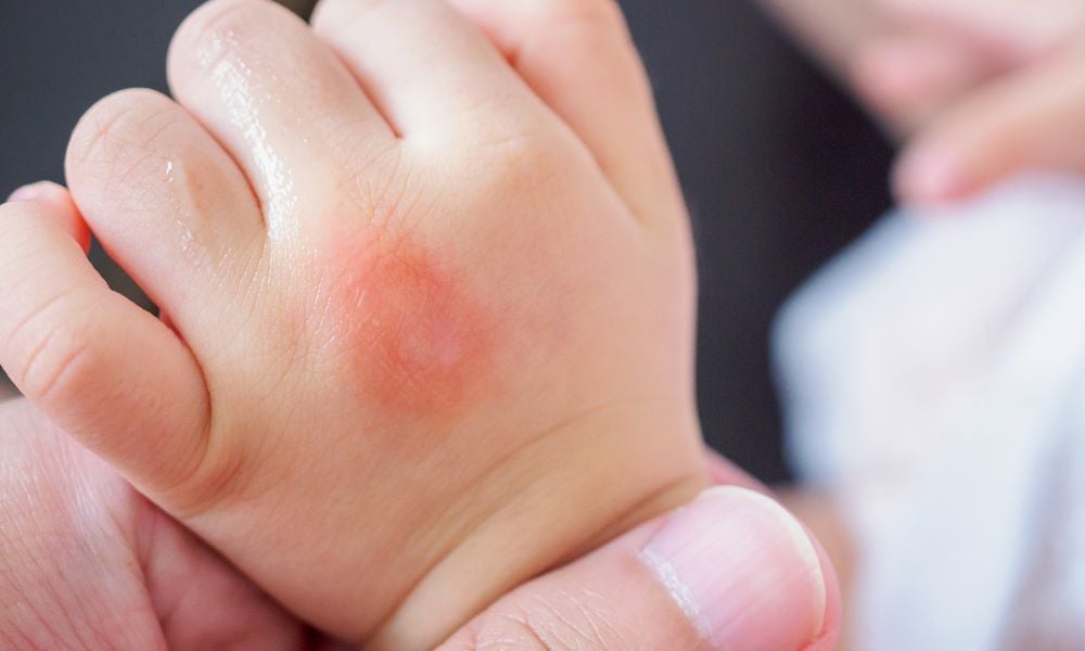 Cách sử dụng vỏ chuối để trị 3 tình trạng ngoài da thường gặp- Ảnh 2.