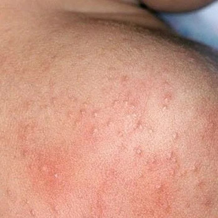 Que faire en cas d'éruption cutanée due à la chaleur pendant l'été ? - Image 1. Mùa hè nhiều rôm sảy cần xử trí ra sao?- Ảnh 1.