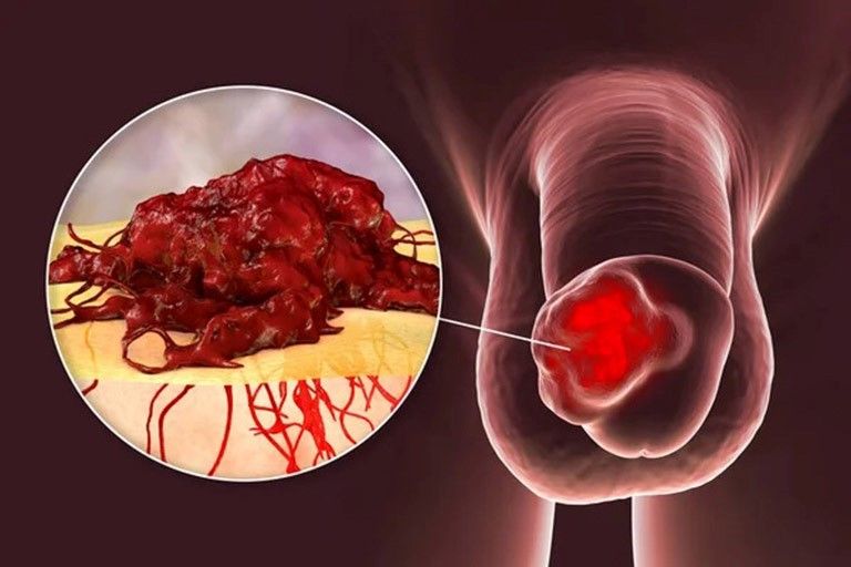 Các dấu hiệu sớm của ung thư dương vật- Ảnh 1.