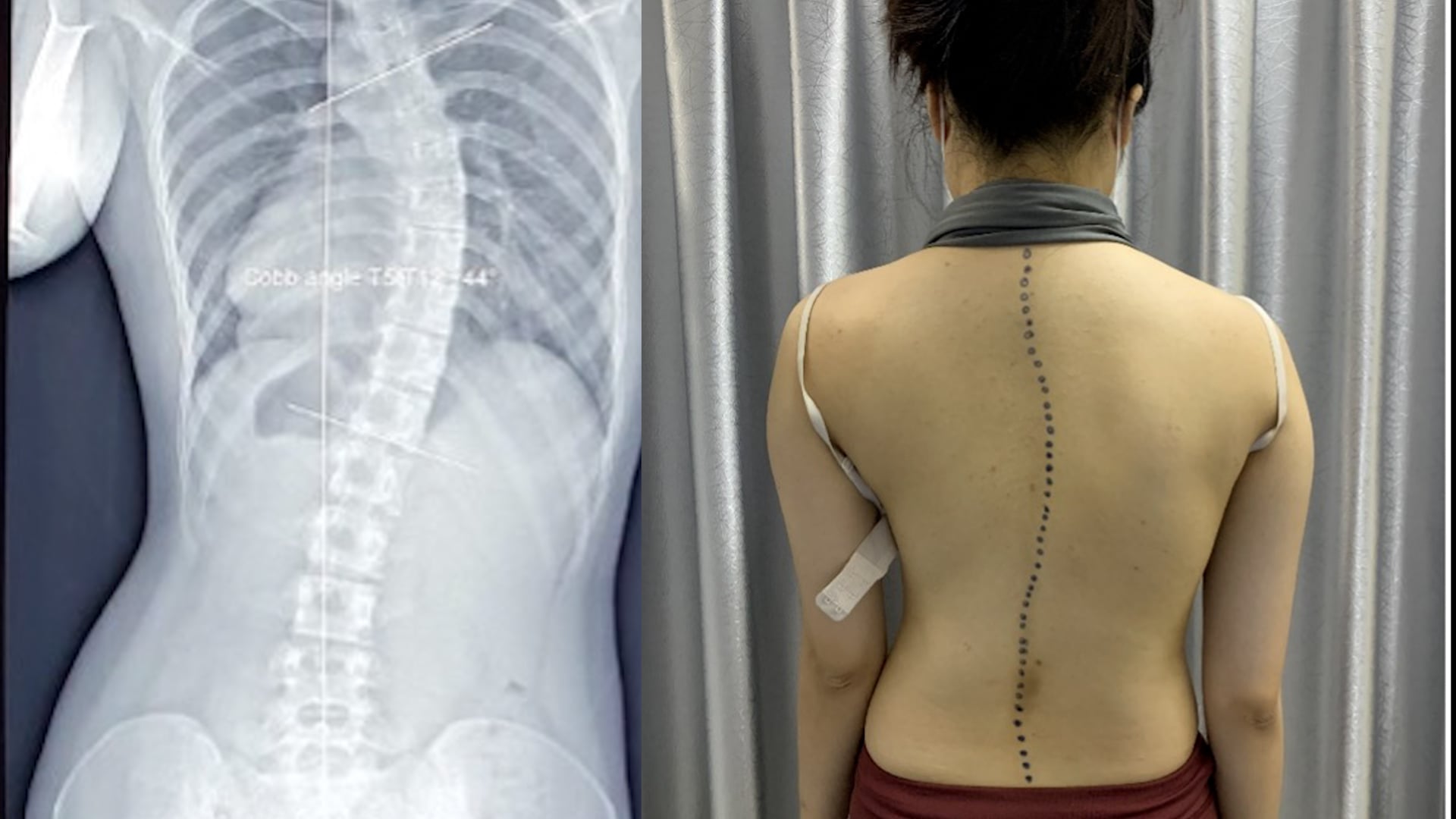 Vẹo cột sống ở trẻ gây hệ lụy gì?- Ảnh 1.