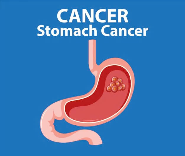 H. pylori bakterisinin mide kanserine neden olup olmadığına dair gerçek - Resim 2.