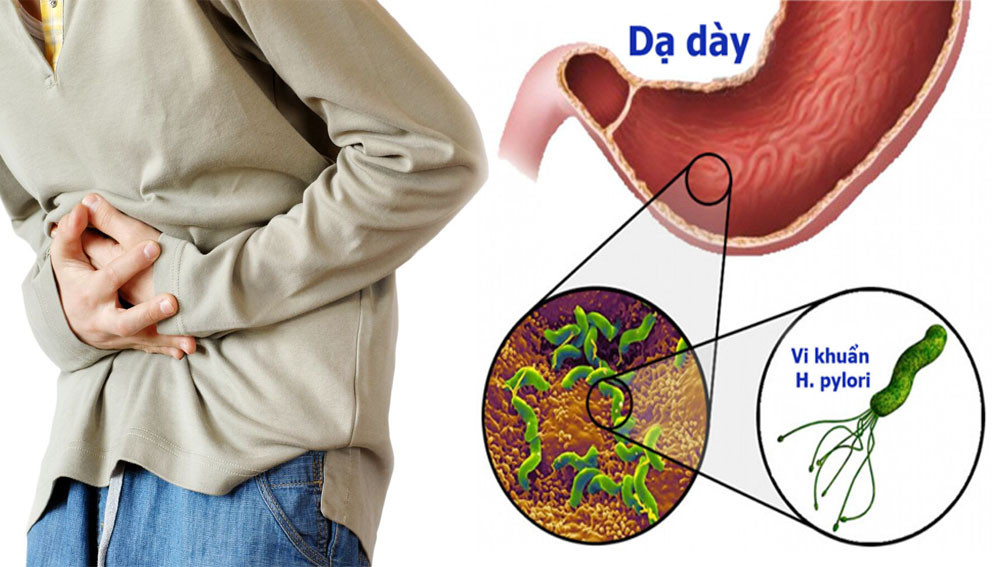 5 dấu hiệu cảnh báo đường ruột "có vấn đề", điểm thứ 2 đặc biệt cần lưu ý