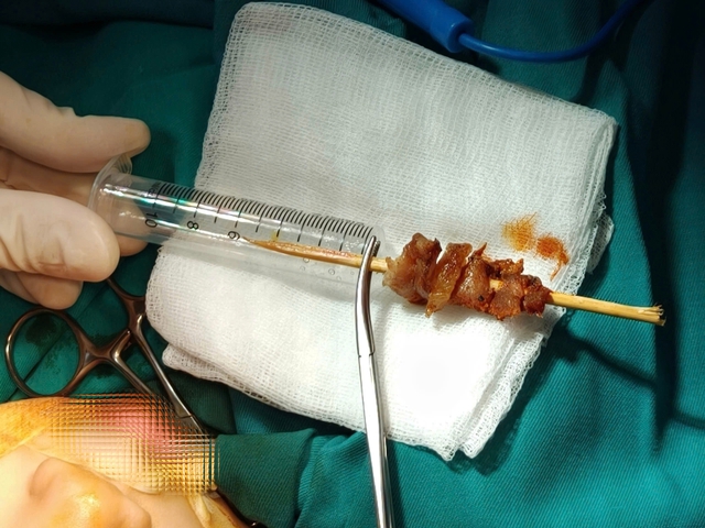 Bé gái 2,5 tuổi bị que xiên thịt đâm sâu đến hốc mắt  - Ảnh 1.