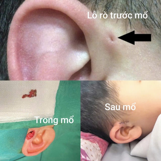 Hi hữu ca rò luân nhĩ di truyền qua 3 thế hệ- Ảnh 2.