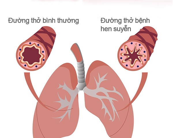 Cách phòng ngừa bệnh hen suyễn và bác sĩ chữa hen giỏi Hà Nội