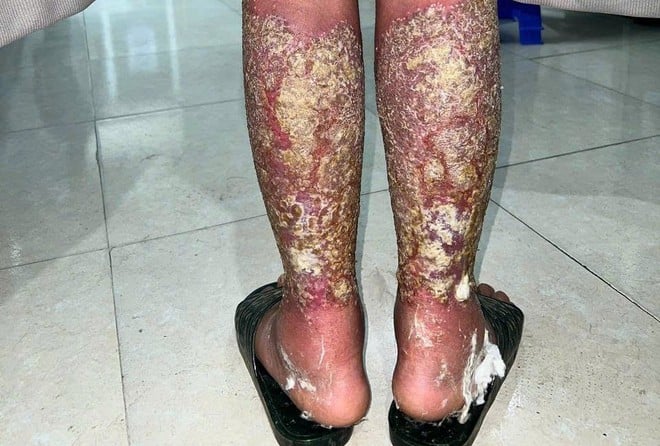Seorang pesakit wanita daripada kumpulan etnik Hmong menghidap psoriasis pustular umum - Foto 2. Nữ bệnh nhân dân tộc Mông đau đớn vì căn bệnh vảy nến mủ toàn thân- Ảnh 2.