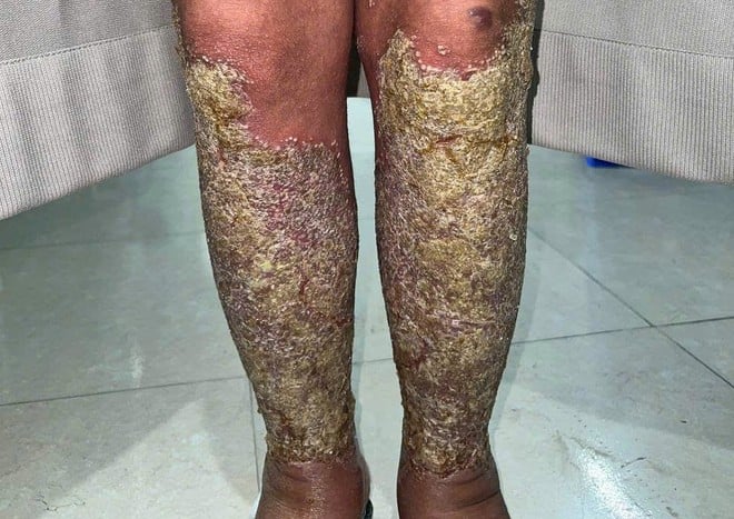 Seorang pesakit wanita daripada kumpulan etnik Hmong mengalami psoriasis pustular umum yang teruk - Foto 3. Nữ bệnh nhân dân tộc Mông đau đớn vì căn bệnh vảy nến mủ toàn thân- Ảnh 3.