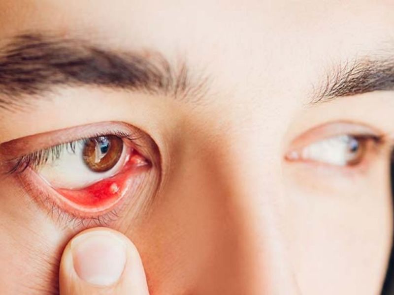 Nguyên nhân gây cộm mắt và cách khắc phục- Ảnh 1.
