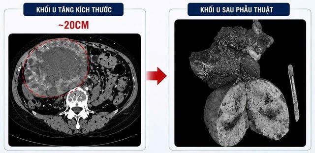 U gan 2 cm 'phình' lên 20 cm do tự điều trị bằng thuốc nam- Ảnh 1.