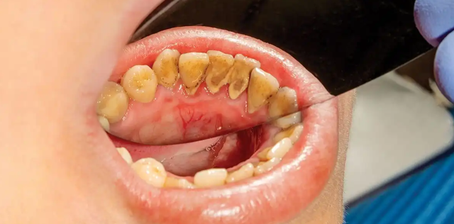 Có cần phải lấy cao răng thường xuyên? - Ảnh 1.