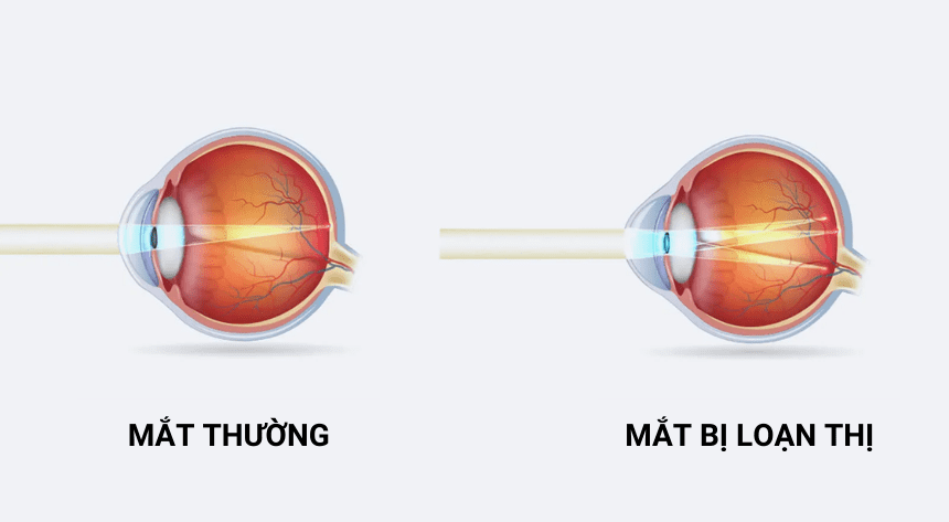Trẻ bị loạn thị có cần đeo kính không?- Ảnh 1.