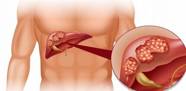 Xơ gan có phục hồi được không?- Ảnh 1.
