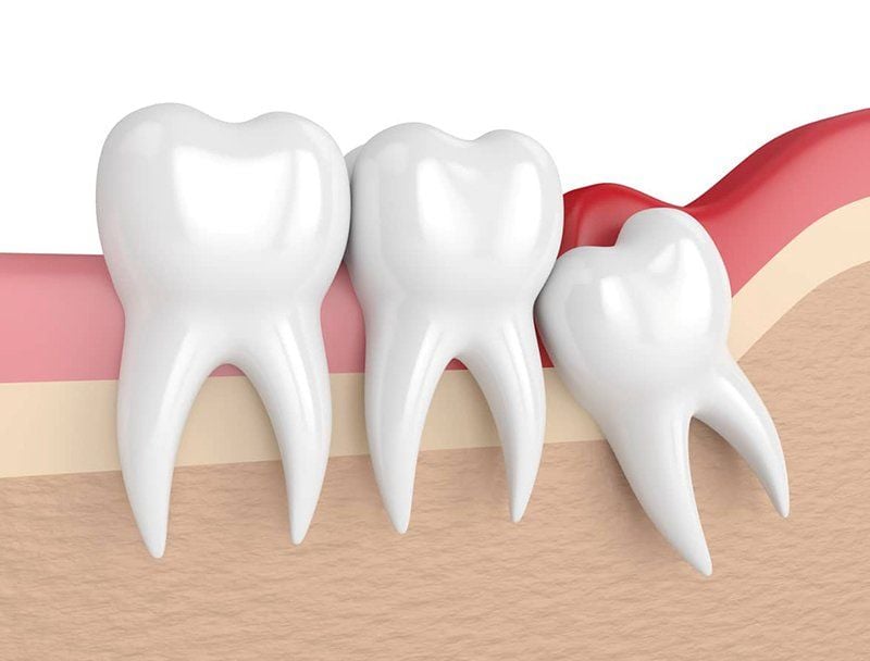Răng số 8 mọc lệch không đau có cần nhổ?- Ảnh 2.