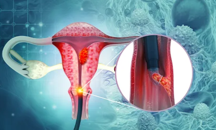 Kunnen vrouwen die de menopauze hebben doorgemaakt nog steeds baarmoederhalskanker krijgen? - Afbeelding 1.
