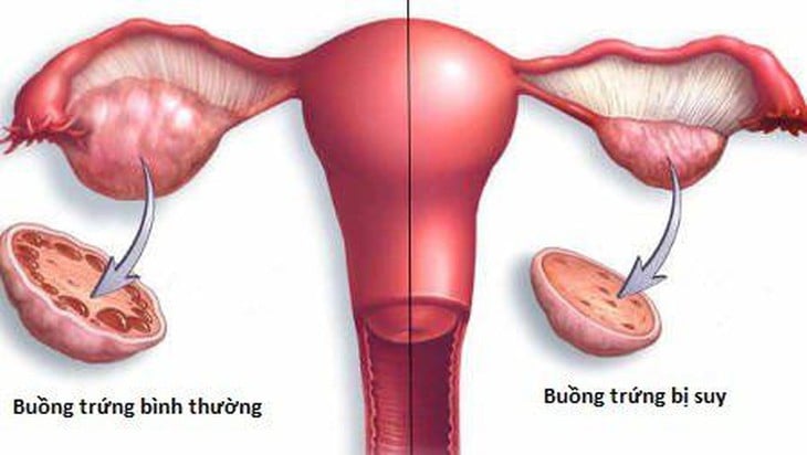 انقطاع الطمث لا يعني سن اليأس - الصورة 1. Vô kinh không đồng nghĩa với mãn kinh- Ảnh 1.