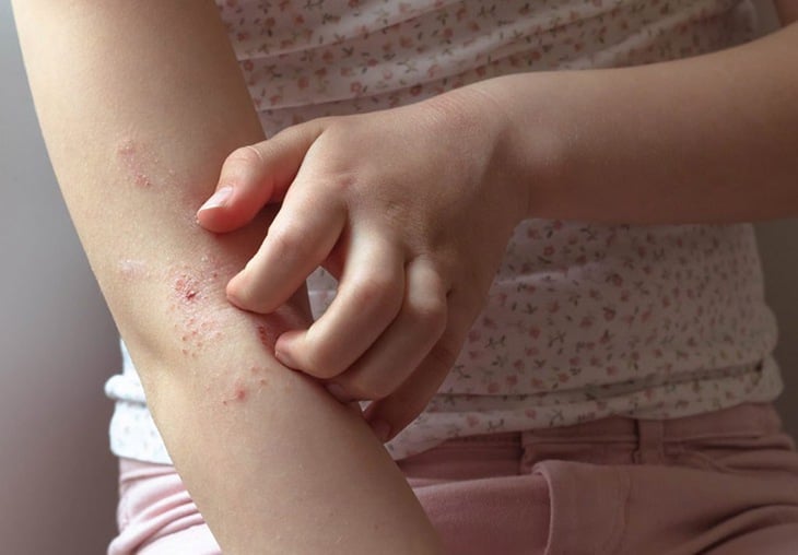 Dấu hiệu ngứa do ký sinh trùng- Ảnh 1.