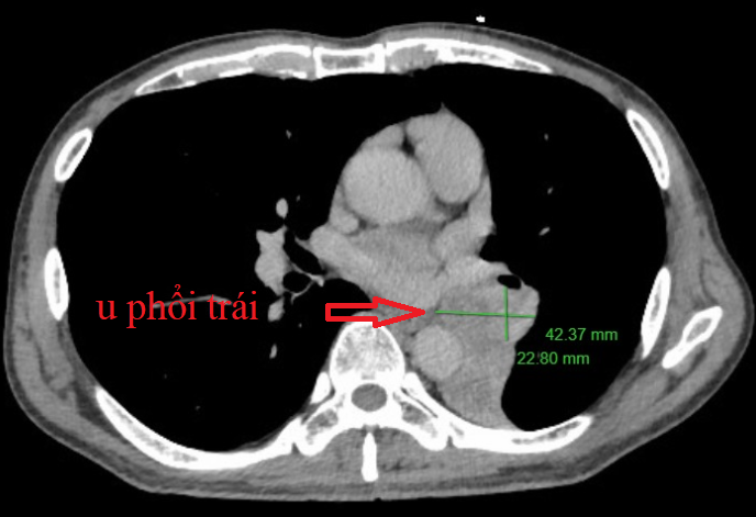 Afbeelding van de tumor