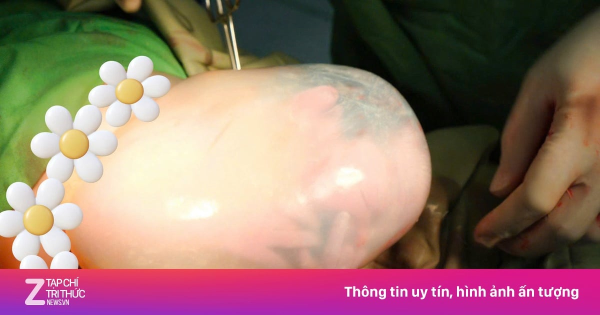 Rare “En Caul” Birth: IVF Twins Born in Hanoi Hospital
