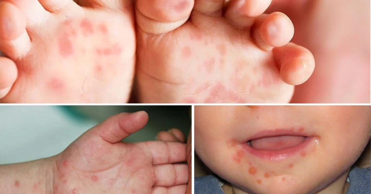 Hampir 100.000 kasus penyakit tangan, kaki, dan mulut: Anak-anak kembali ke sekolah, risiko penyebaran meningkat.