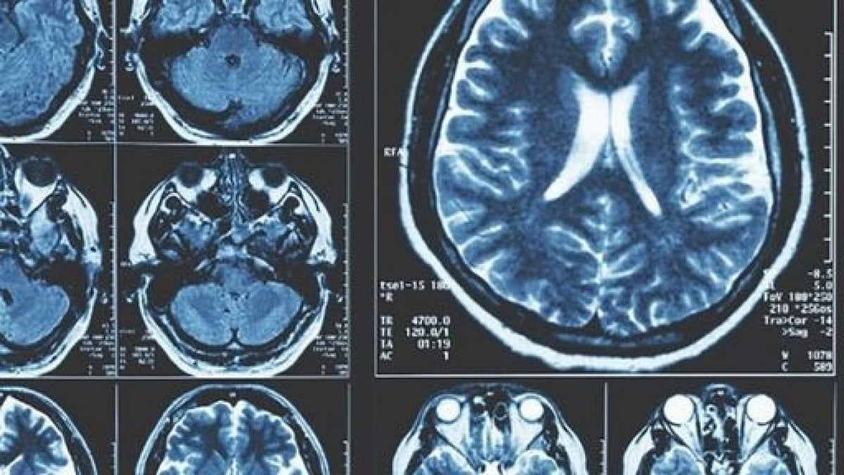 New Research Directions for Parkinson Disease Treatment - News Directory 3