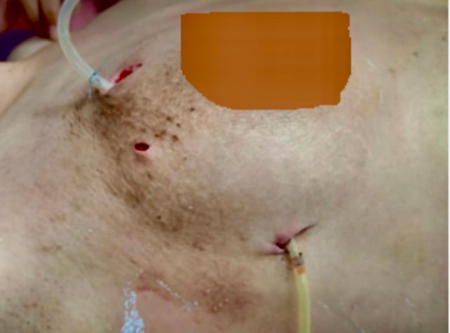 Ngực biến dạng do tiêm filler làm đẹp- Ảnh 1.