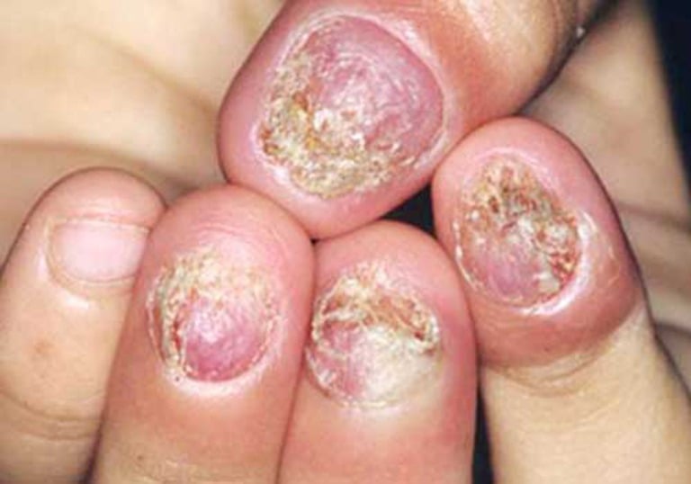 Điều trị hiệu quả nấm móng tay, móng chân- Ảnh 2.